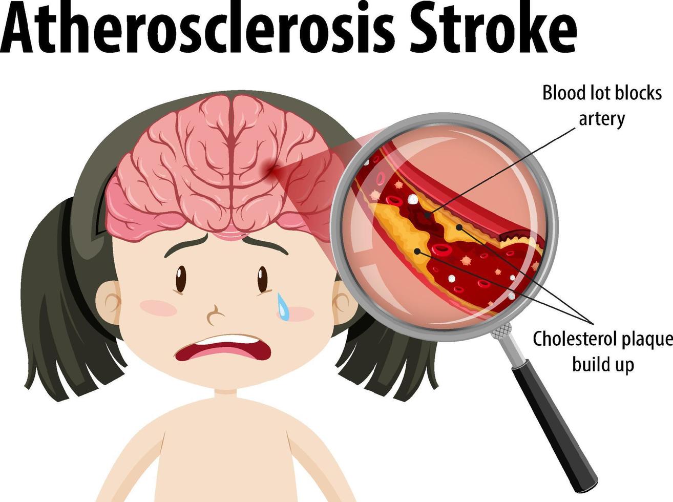 mänsklig anatomi med ateroskleros stroke vektor