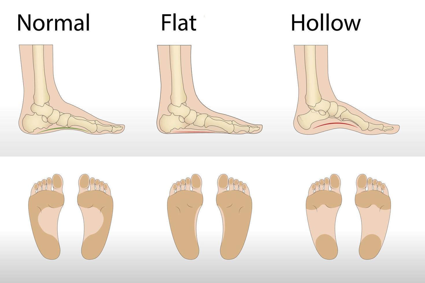 fotdeformitetstyper, medicinsk sjukdomsinfografik. ihålig, platt och normal fot. vektor