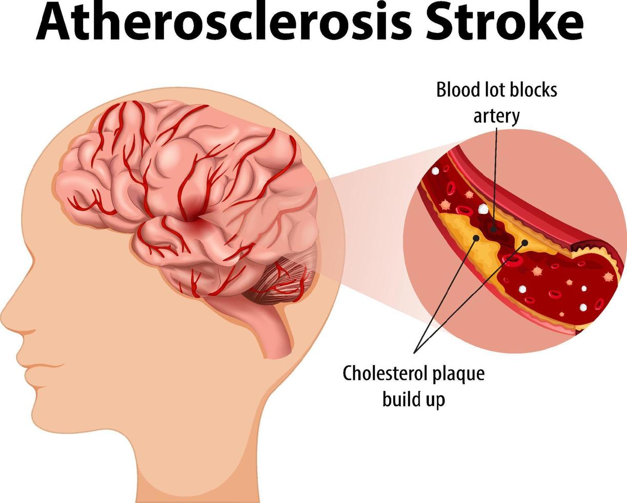 menschliche anatomie mit atherosklerose-schlaganfall vektor