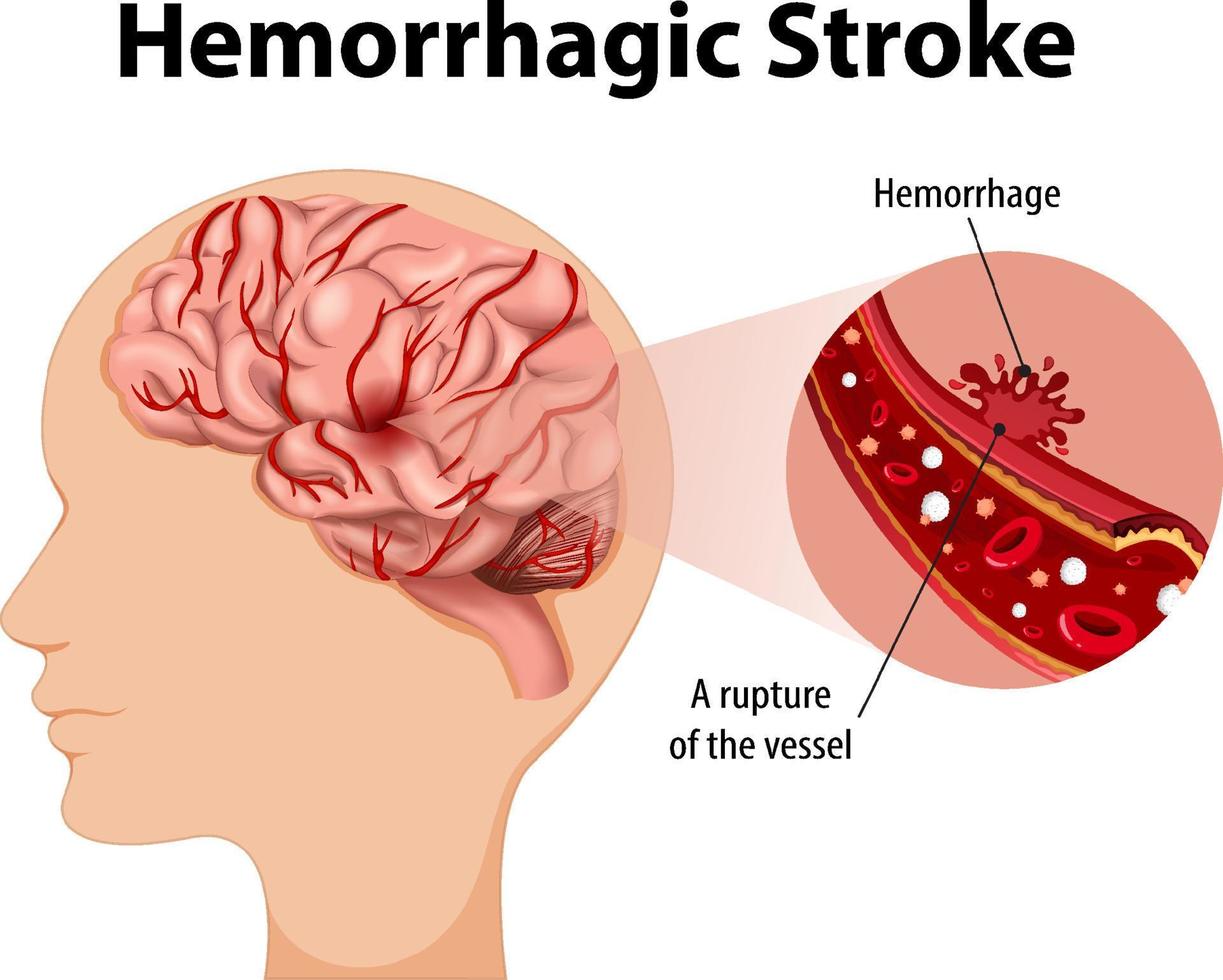 Mensch mit hämorrhagischem Schlaganfall vektor