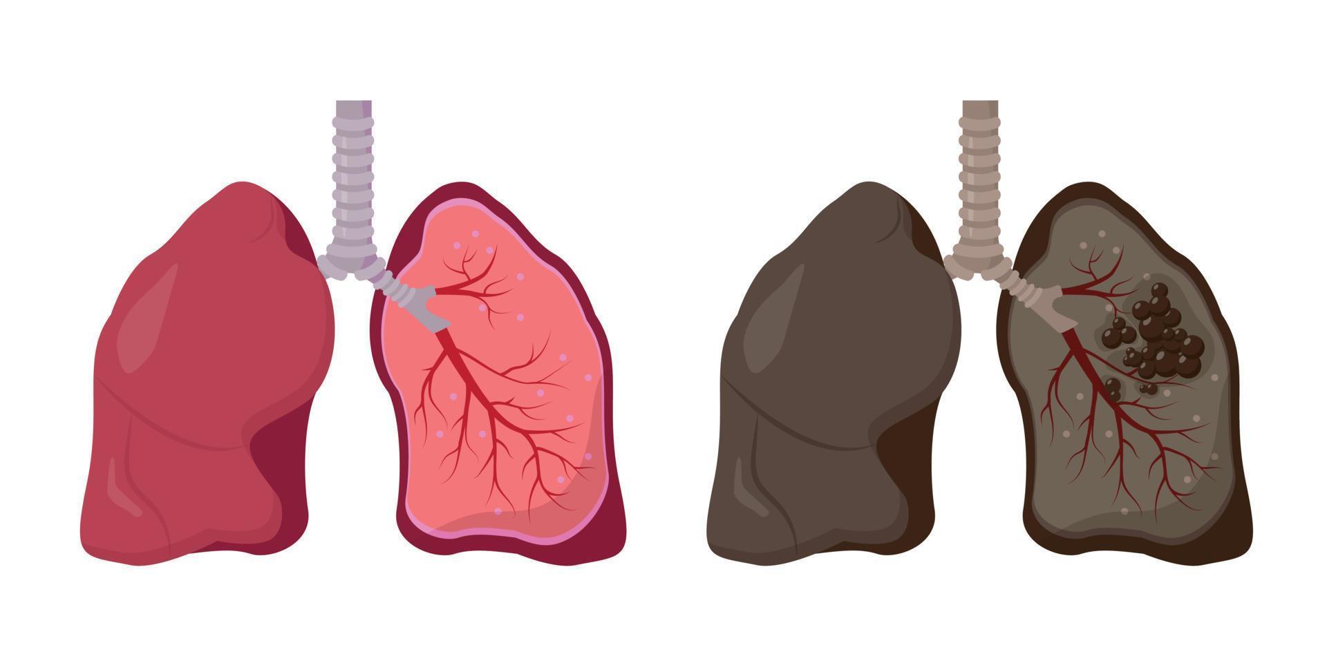 friska och ohälsosamma mänskliga lungor. normal lung vs lungcancer. anatomi diagram på vit bakgrund. mänskliga organ ikon. vektor illustration.