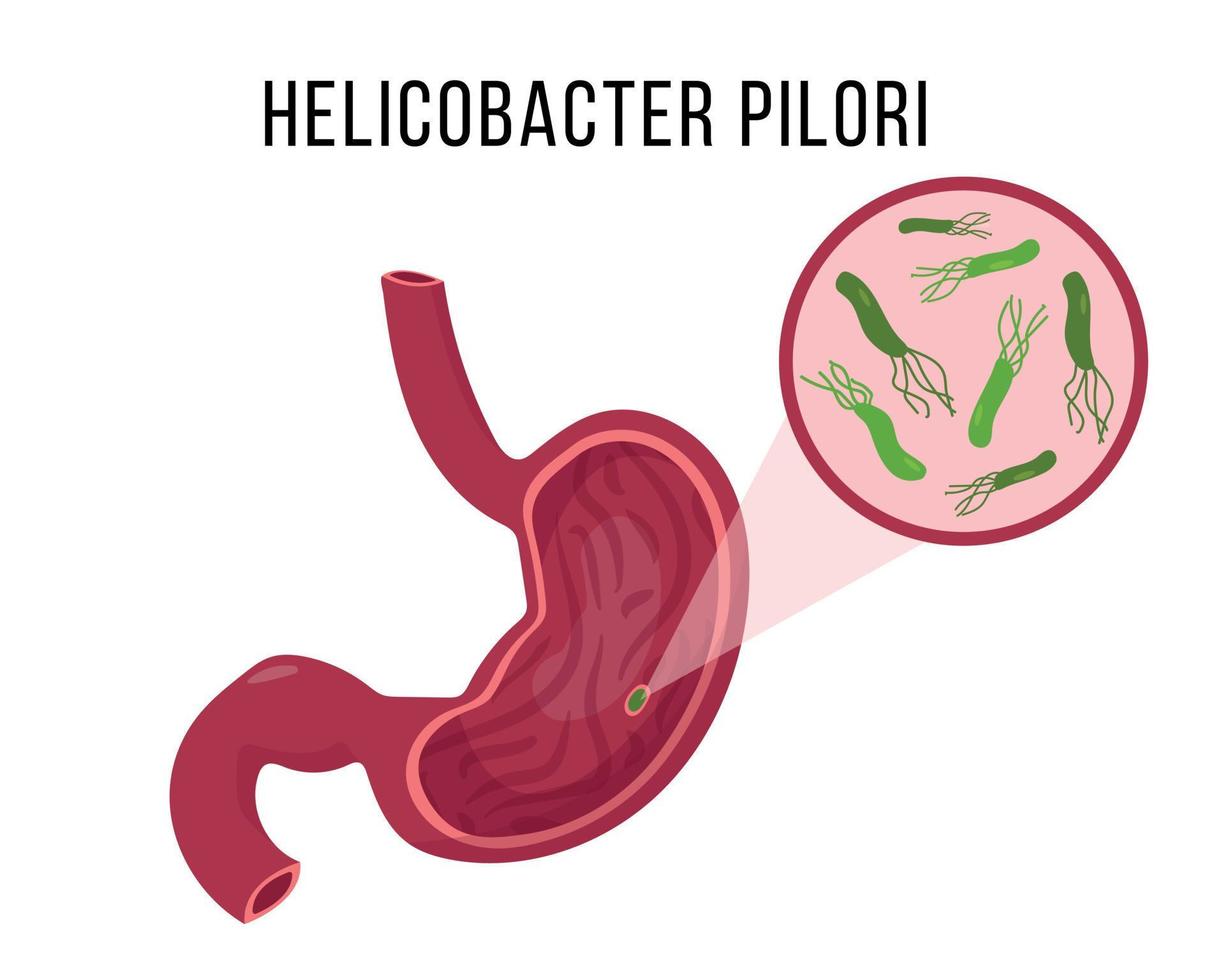 menschlicher Magen infiziert mit Helicobacter pilori. medizinisches Konzept. magenkrankheitsillustration auf weißem hintergrund. vektor