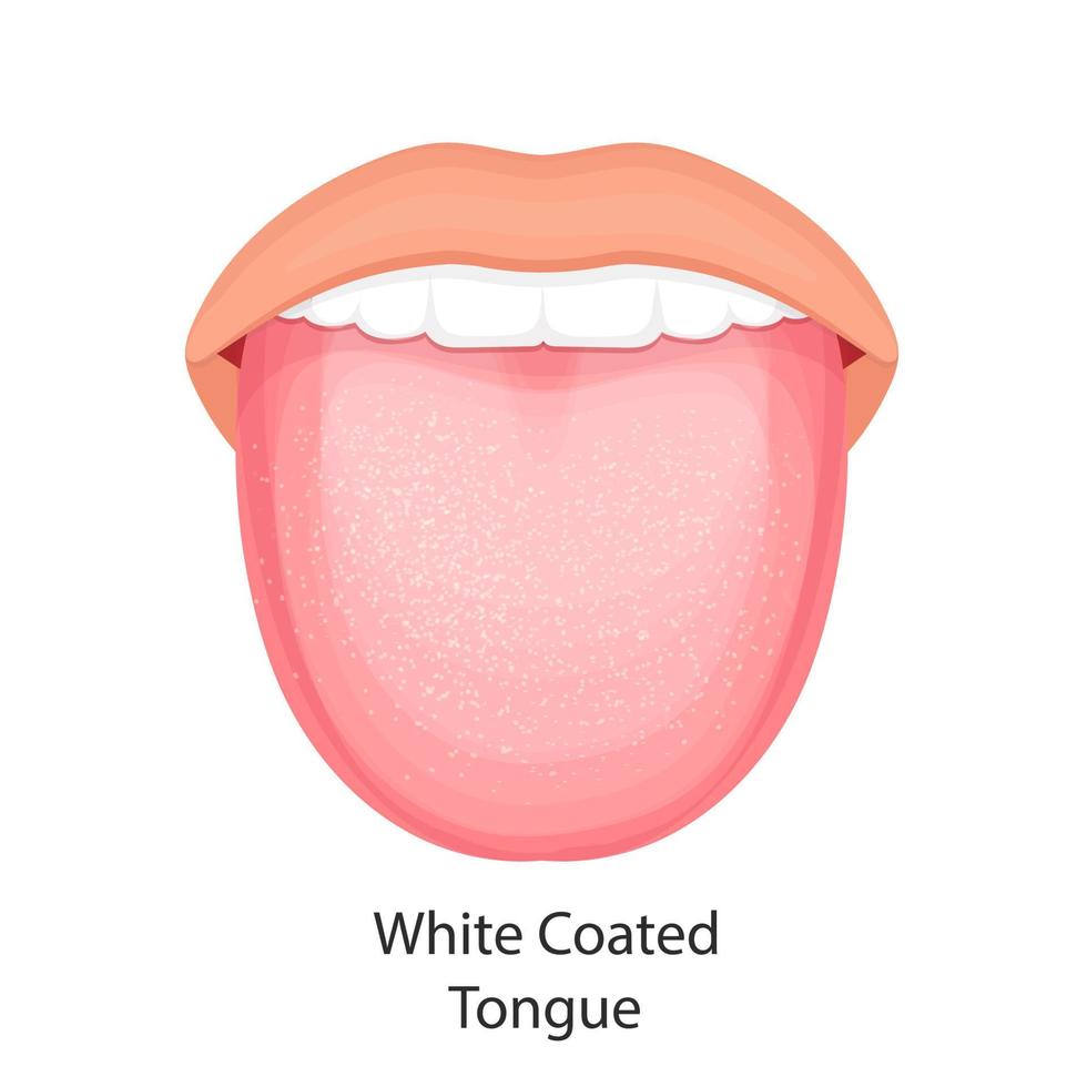 anatomi i munhålan. vektor illustration av tungan med vit beläggning.