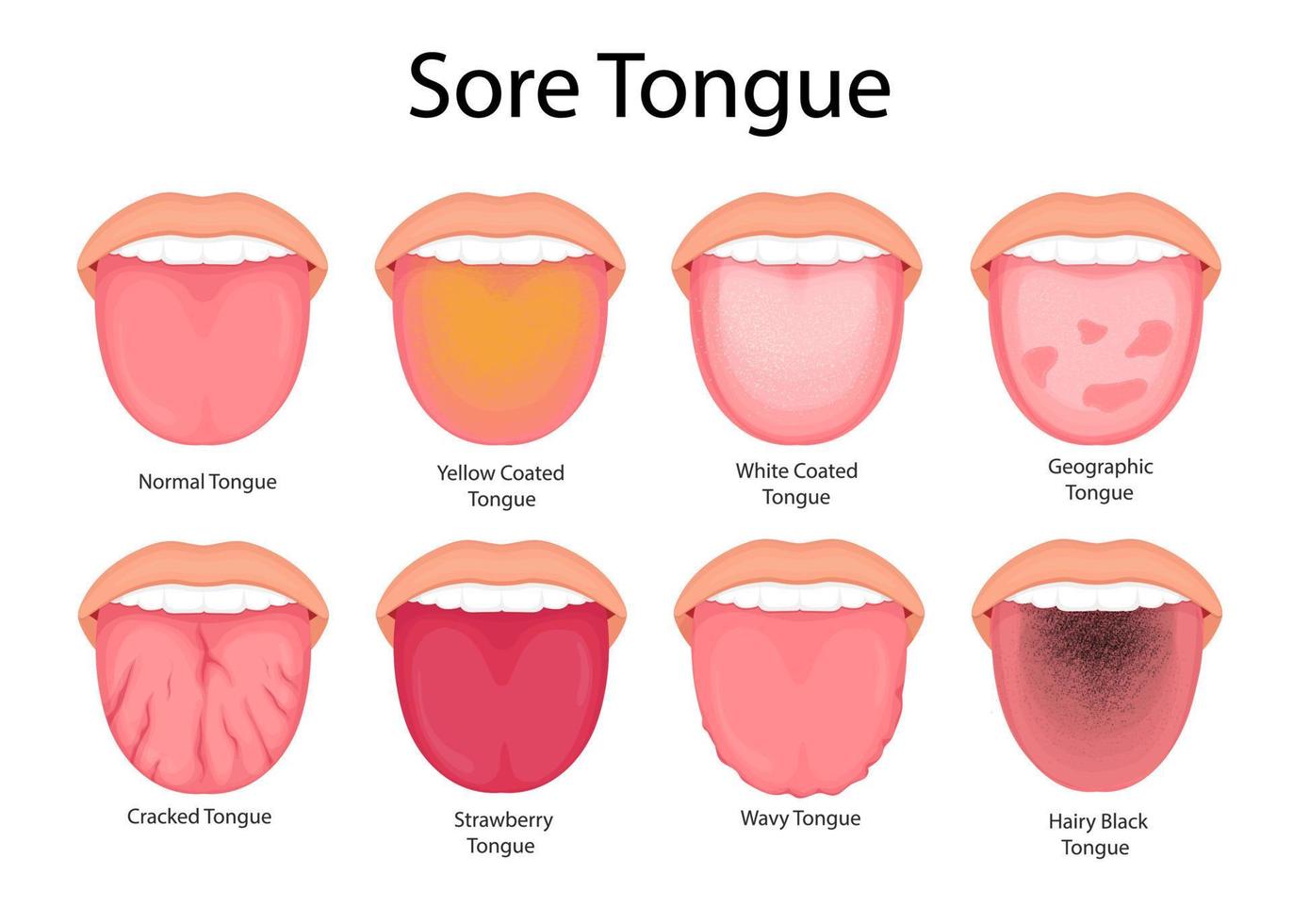 illustration av tunga symptom och hälsa. medicinsk illustration. vektor