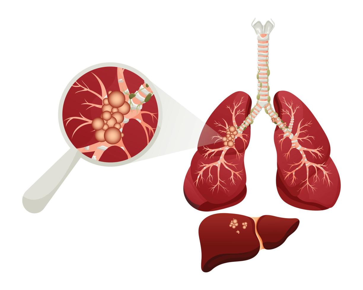 Diagramm Lungenkrebserkrankung. Konzept Krankheit innere Organe des Menschen. vektorillustration, karikaturart. vektor