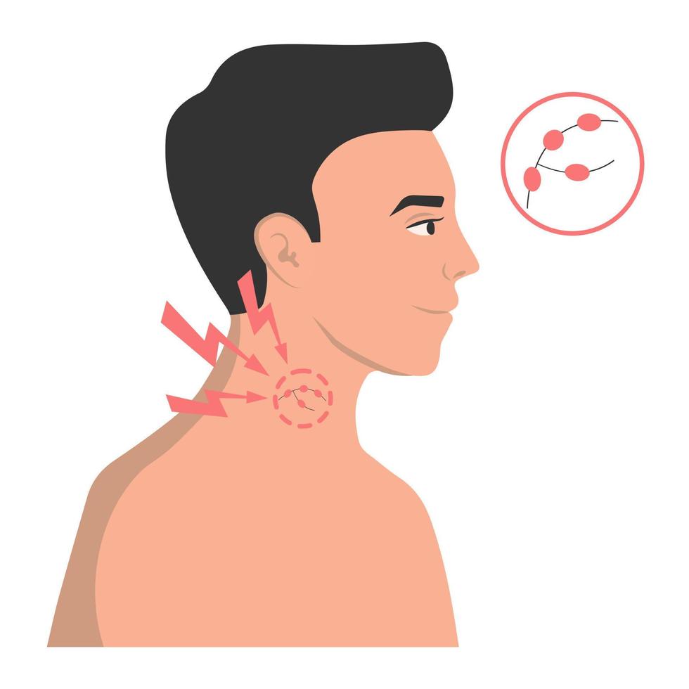 svullna lymfkörtlar som ett symptom på virus, influensa, förkylning. vektor illustration.