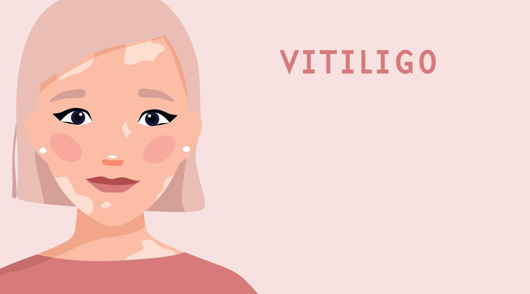 Porträt eines Mädchens mit Vitiligo. Selbstliebe. Welt-Vitiligo-Tag. Hautkrankheiten. Vektorillustration im Cartoon-Stil mit Platz für Text vektor