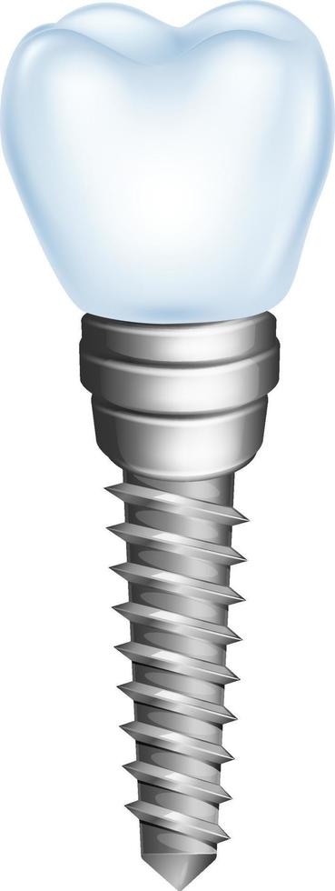 illustration av tandimplantat isolerad på vit bakgrund vektor