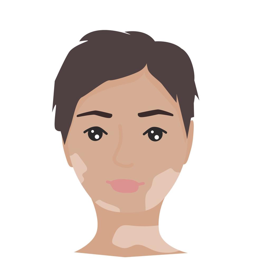 Porträt einer Frau mit Vitiligo. selbstakzeptanz, selbstliebekonzept. Poster, Banner, Karte Welt-Vitiligo-Tag vektor