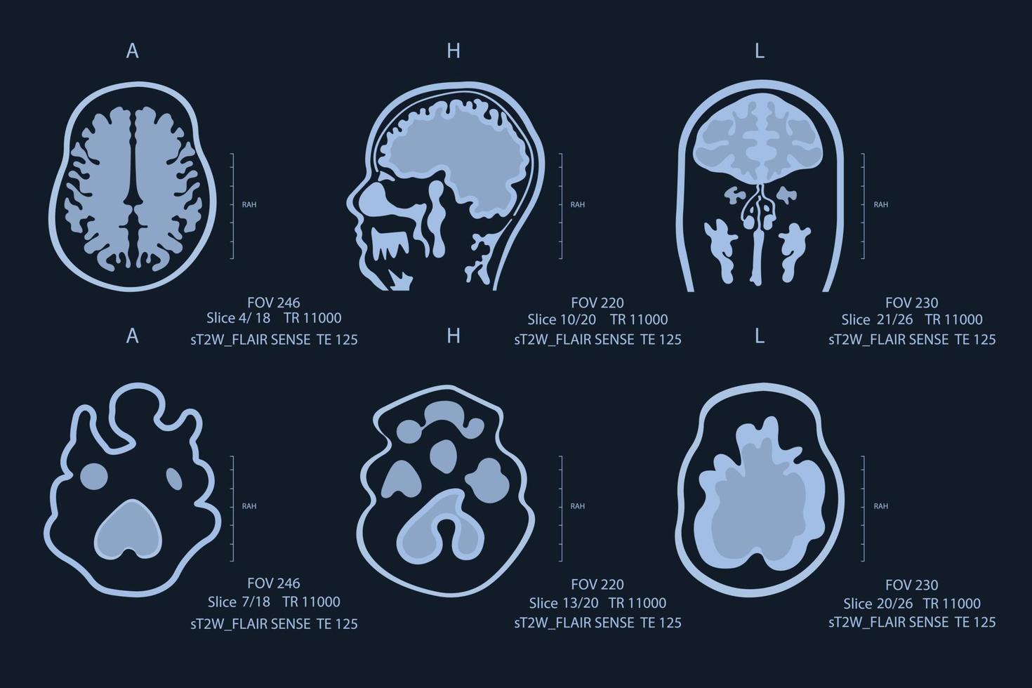 Bild des Gehirnscans eines älteren Mannes auf MRT-Magnetresonanztomographiefilm für die neurologische medizinische Diagnose des Gehirns. vektor