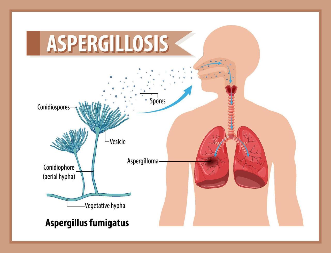 Diagramm, das eine Aspergillus-Infektion zeigt vektor