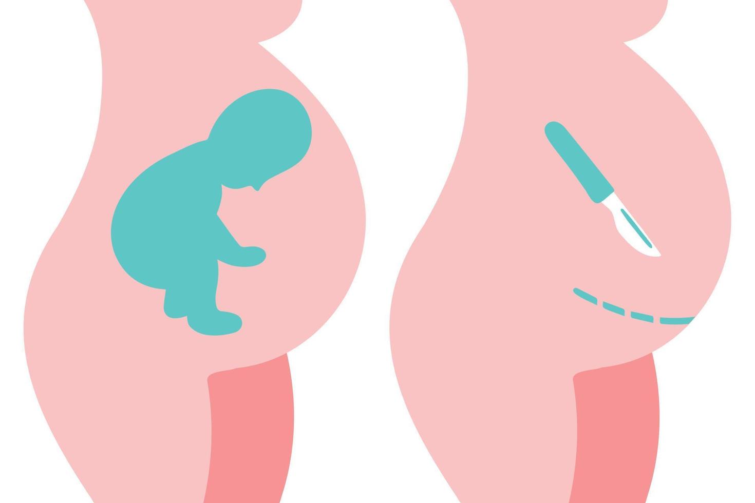 sätespresentation. fostrets babypositioner i livmodern under graviditeten. kejsarsnitt platt ikon. skalpell nära magen. kirurgisk operation för förlossning. vektor