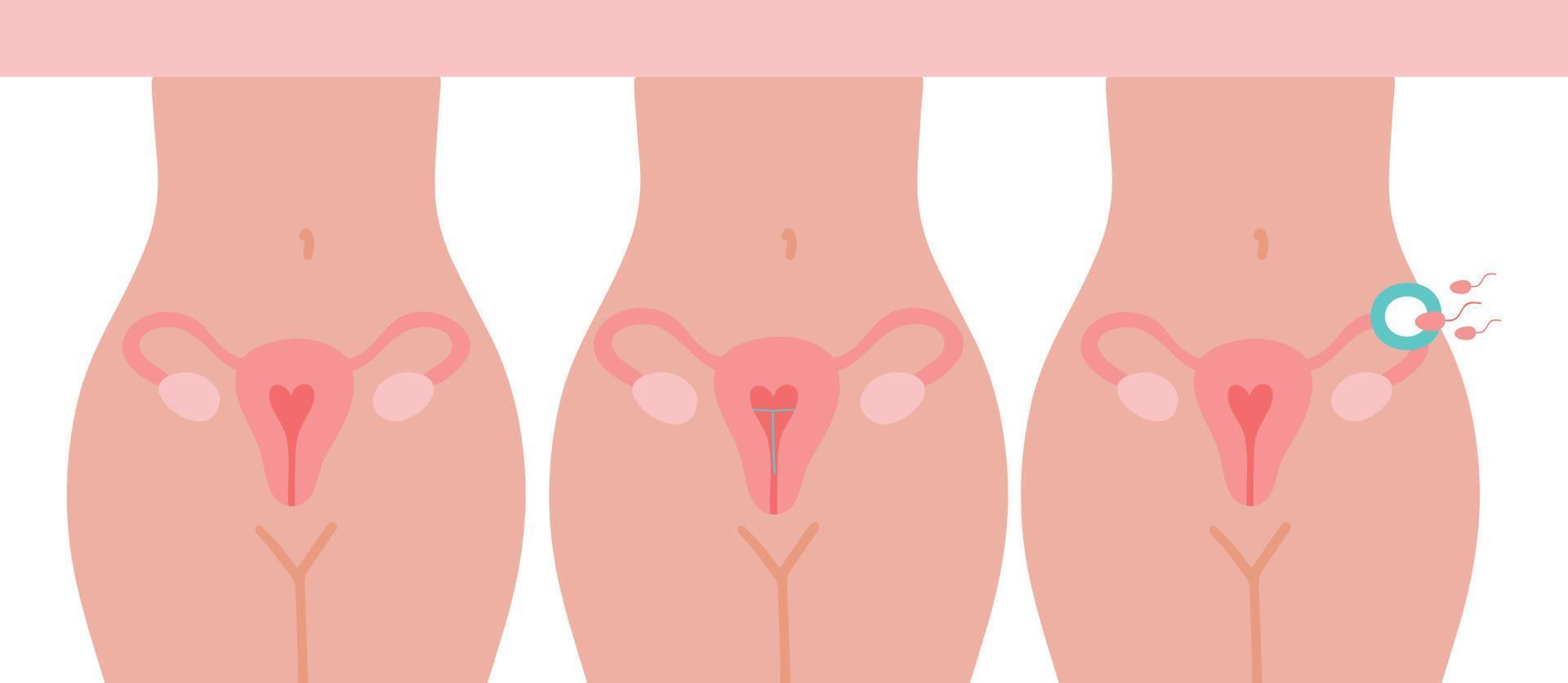 Symbol für Befruchtung. Gebärmutter, Sperma, Insemination. Befruchtung im Eileiter. die methode der iud-empfängnisverhütung ist nicht isoliert. vektor