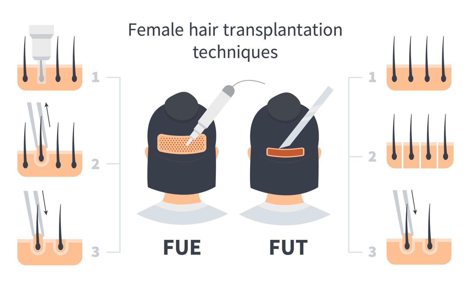 fue- und fut-Vergleich der weiblichen Haartransplantation, Stadien der Extraktion der follikulären Einheit. Behandlung von Glatzenbildung, Alopezie und Haarausfall. Vektor medizinische Infografik, Kopf und Nacken der Frau