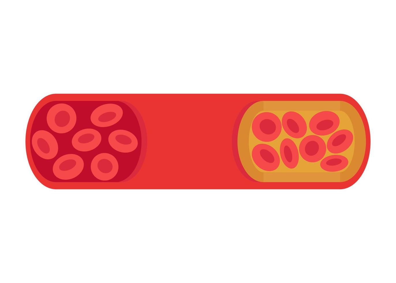 Wechsel des Gefäßes von einer normalen zu einer cholesterinblockierten Arterie. Blutgerinnsel, Thrombus, atherosklerotische Plaque. tiefe Venenthrombose dvt oder arterielles Gerinnsel, Blutgefäßfluss. Kreislauf blockiert. Vektor