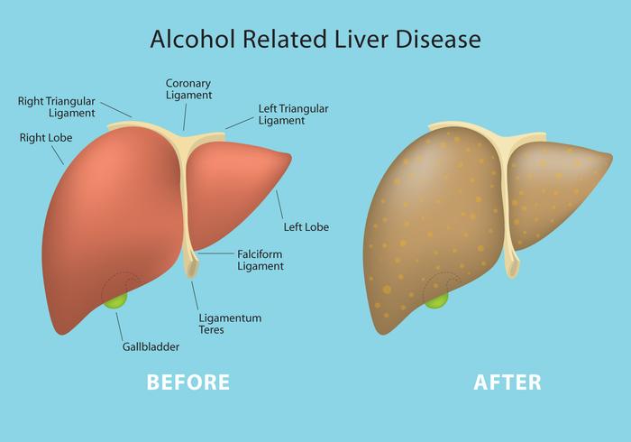 Alkoholrelaterad leversjukdom Vector Info