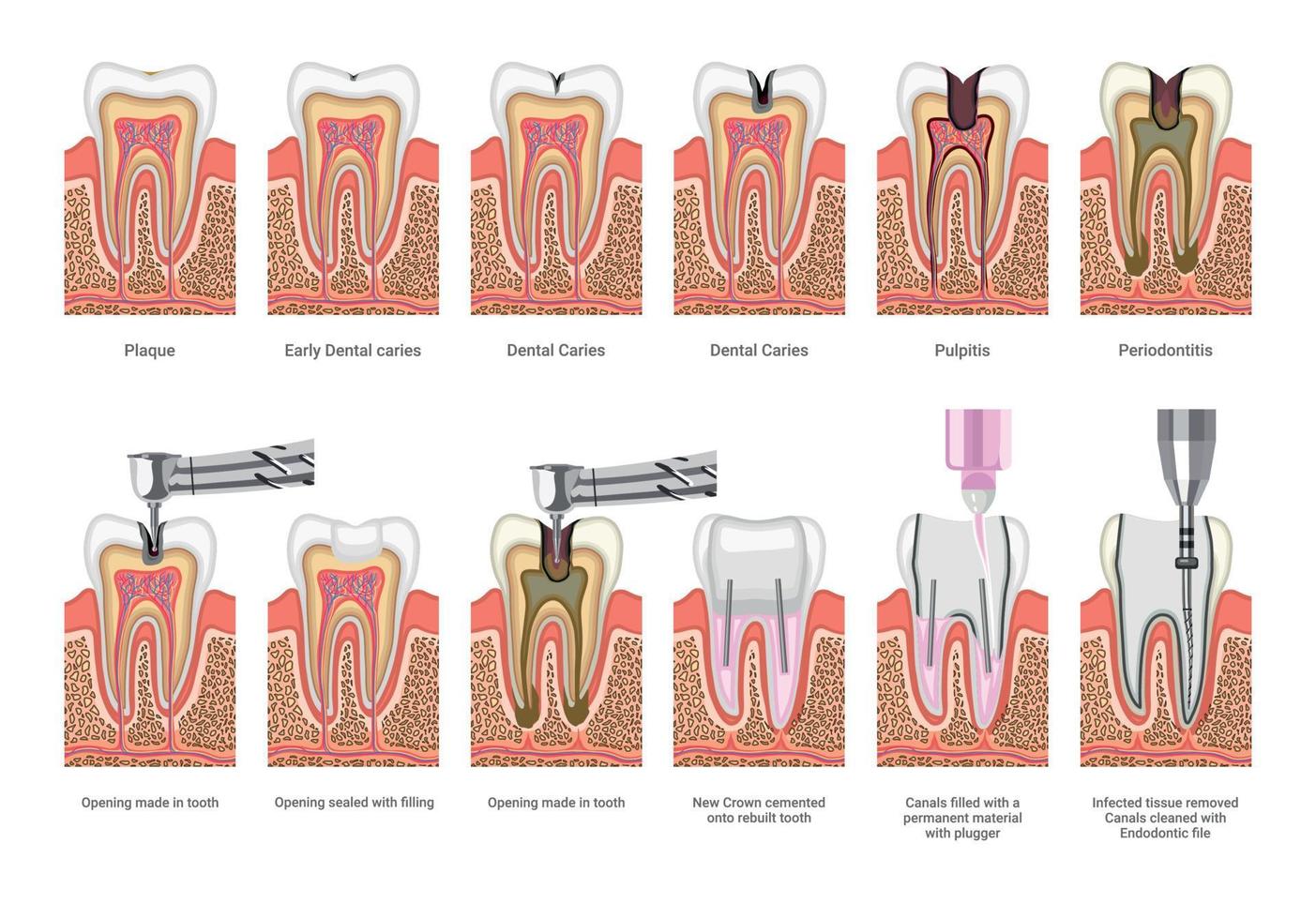 tandkaries och behandlingsillustrationer vektor