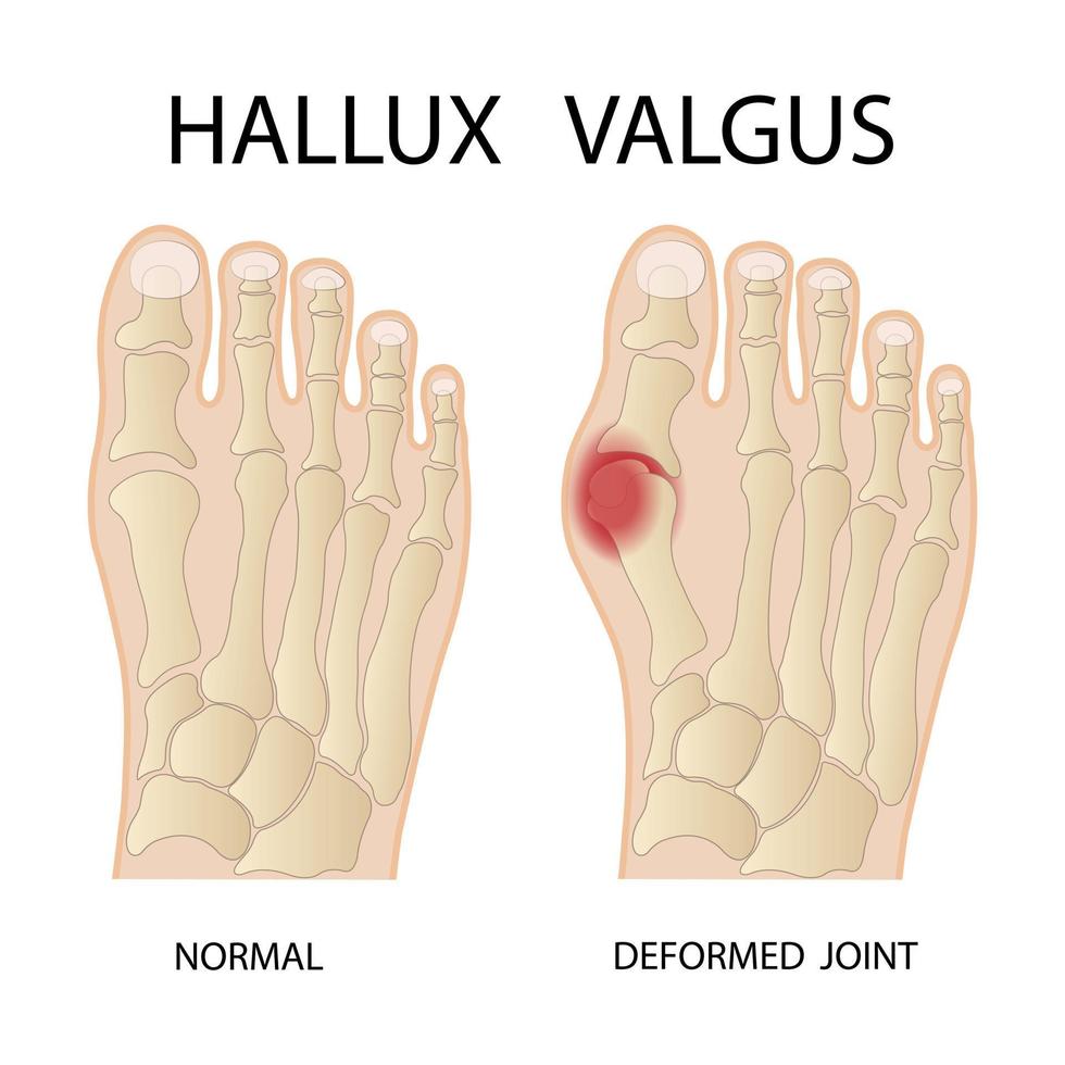 hallux valgus medicinsk infografik. vektor illustration.