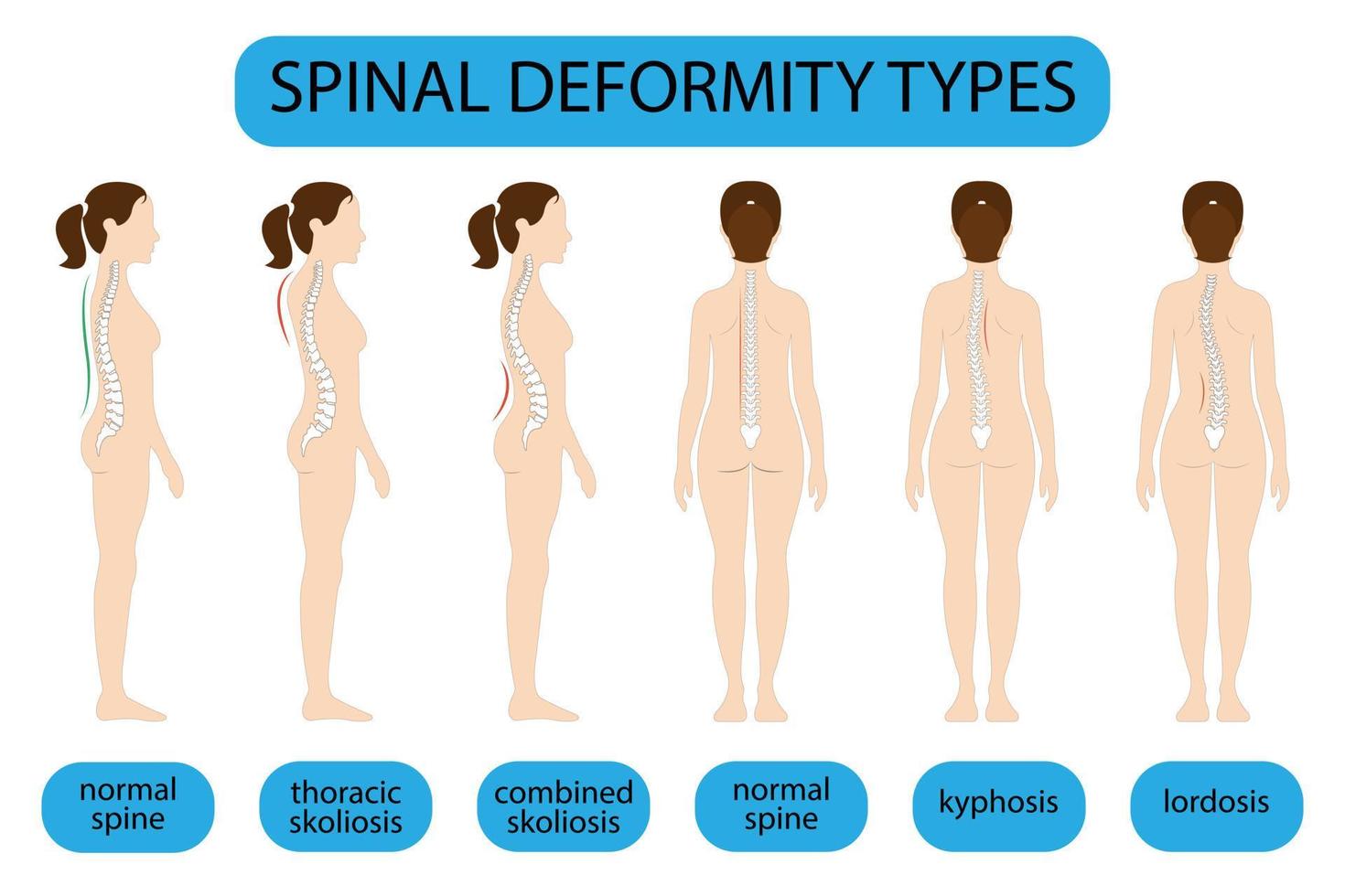 ryggradsdeformationstyper och frisk ryggradsjämförelsediagram affisch med ryggradskurvaturer. kvinnlig profil och bakifrån. kiropraktisk information. vektor