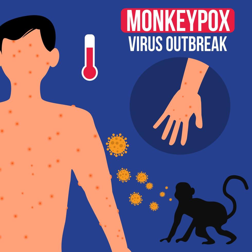 Affenpocken-Virus-Ausbruchsillustration geeignet für Poster und Infografik vektor