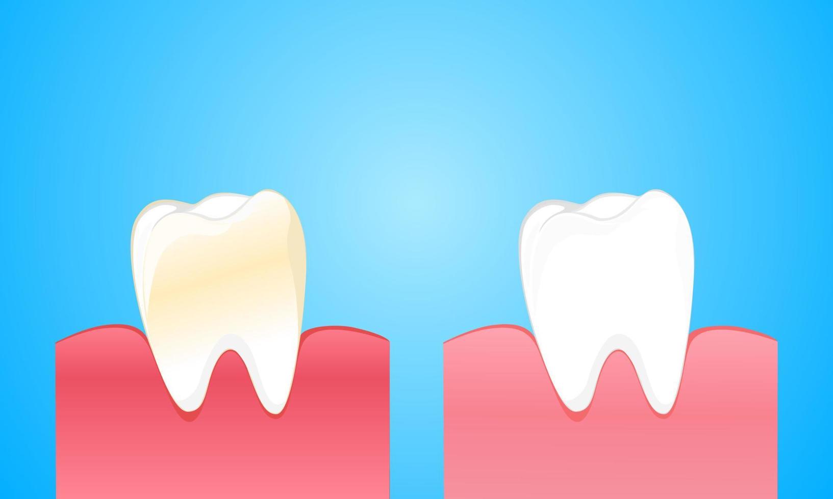 smutsig tand och tandkött jämför med ren och stark vit tand vektor