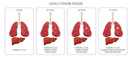Lungenkrebs Stadien. Konzeptkrankheiten der inneren Organe des Menschen. Cartoon-Stil, Vektorillustration. vektor