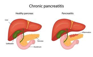 Krankheit Pankreatitis, Infografik. Leber und Bauchspeicheldrüse. Vektorillustration im Cartoon-Stil. vektor