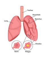 lunginflammation. vanligt och inflammatorisk tillstånd av de lungor och inflammation av de alveolerna med vätska. vektor illustration i tecknad serie stil isolerat på vit bakgrund.
