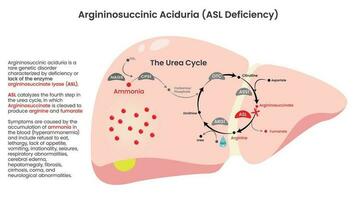 Argininobernsteinsäure-Azidurie-ASL-Mangel-Vektordiagramm vektor