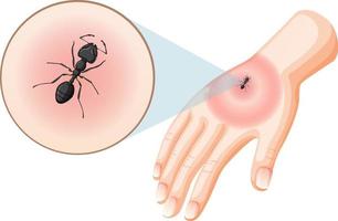 schwarze ameisenbisse stechen auf der haut vektor