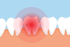 toter zahn, der schmerzt und ein rotes schmerzsignalkonzept gibt. ein schlechter Zahn mit Löchern und einem roten Gefahrensignal. dentaler Infografik-Elemente-Vektor mit einem toten Zahn. stomatologie pflege für die zähne. vektor