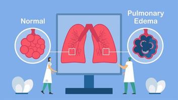 Lungenödem zeigt gute und schlechte Alveolen. vektor