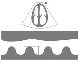 Diagramm der Messung der systolischen Exkursion oder Tapse der Trikuspidalringebene aus dem Echokardiogramm vektor