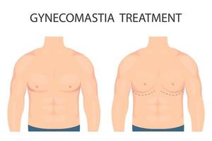 vektor illustration av gynekomasti i män. för reklam kosmetisk plast förfaranden