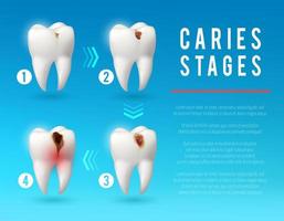 Zahnverfall 3D-Poster zur Entwicklung von Zahnkaries vektor