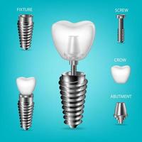 vektor realistisk, 3d uppsättning av dental implantat. strukturell element av en dental implantera, isolerat.