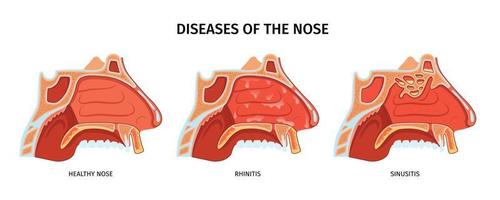Erkrankungen der Nase Poster vektor