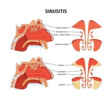 sinusitis infografiken illustration vektor