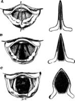 de struphuvud i annorlunda betingelser av de glottis, årgång illustration. vektor