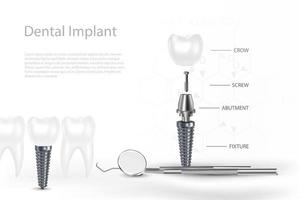 3D-Zahnimplantat-Chirurgiekonzept mit Werkzeug. vektor