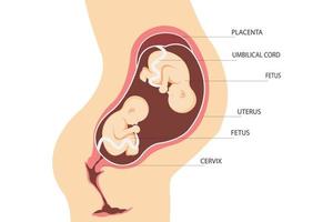 Doppelschwangerschaft. Anatomie der Gebärmutter mit Zwillingsföten. Platzierung zweieiiger Zwillinge. flache Abbildung vektor