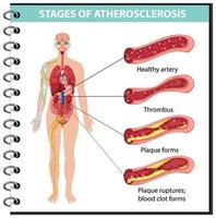 stadier av ateroskleros infografisk vektor