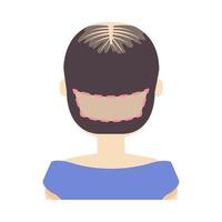 fue Haartransplantation Behandlung von Alopezie. Rückansicht einer Frau bei der Operation. weibliches Haarausfallmuster. medizinische Infografiken. Cartoon-Vektor-Illustration. vektor