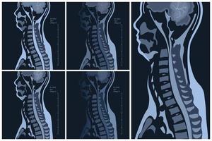 magnetisk resonans avbildning av de cervical ryggrad ryggrad. spondylos och spinal sladd kompression. vektor