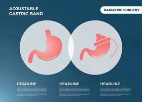 illustration av justerbar mag- band tänka ut vikt förlust kirurgi vektor