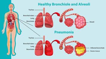 gesund und ungesund der menschlichen Lunge vektor