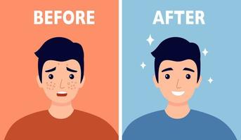 man ansikte acne innan och efter hud vård behandling i platt design. vektor