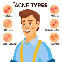 acne typer vektor. man med acne. ansiktsbehandling hud problem. papule, pustulem skåror. isolerat platt tecknad serie karaktär illustration vektor