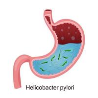 helicobacter pylori i mage. vektor illustration, tecknad serie stil, vit bakgrund