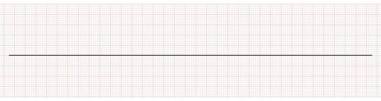 EKG mit flacher Linie oder Asystolie vektor